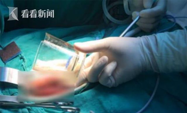 Пациент отказался объяснять врачам, откуда в его заднице взялся стакан